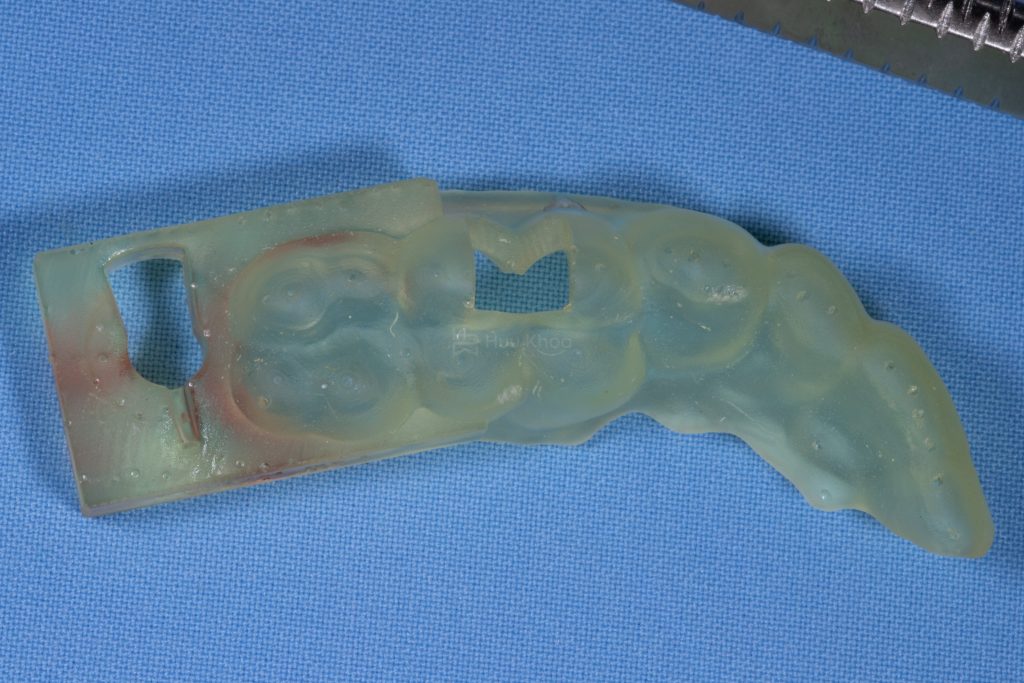 Máng hướng dẫn phẫu thuật (surgical Guide Template)